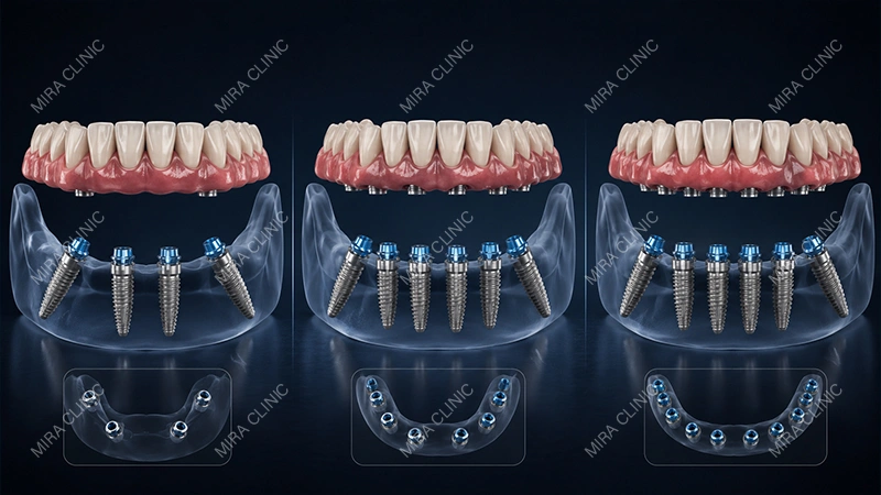 All-on-4 vs All-on-6 vs All-on-8 Implants